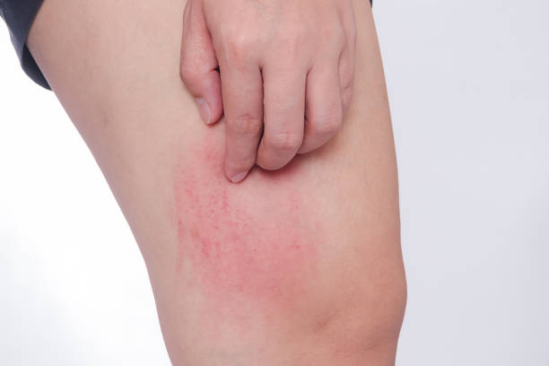 Scratch Allergic skin from mosquito bites stock photo