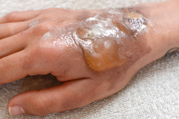 Second degree burnt female hand. severe skin damage stock photo