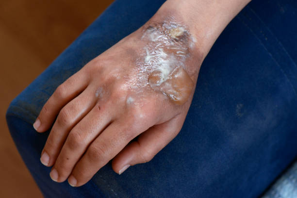 Second degree burnt female hand. severe skin damage stock photo