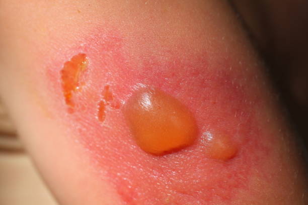 Second-degree sunburn on the skin of a child in the blisters￼ stock photo