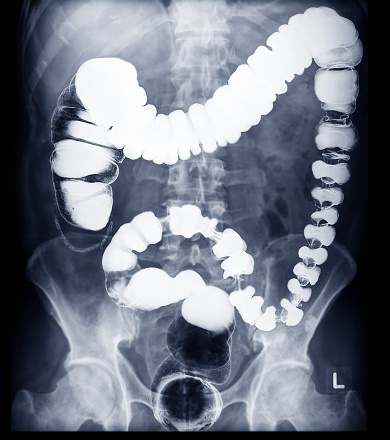 Selective Focus Of Barium Enema Image Or Xray Image Of 