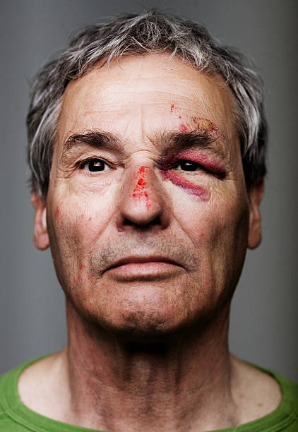Senior Man with Bruised and Black Eye  black eye stock pictures, royalty-free photos & images