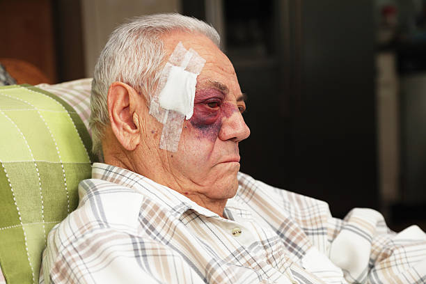 Senior Man With Injured Face and Black Eye is Unhappy A senior man with a dreadful blotchy black and blue (and red) eye also has a large bandage covering several medical stitches in his temple after suffering a bad fall. He is not very happy about the situation! black eye stock pictures, royalty-free photos & images