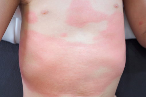 Severe Eczema Skin Rash And Allergic Reaction Symtom At Little Asian Child  Body Cause By Hypersensitivity Stock Photo - Download Image Now - iStock