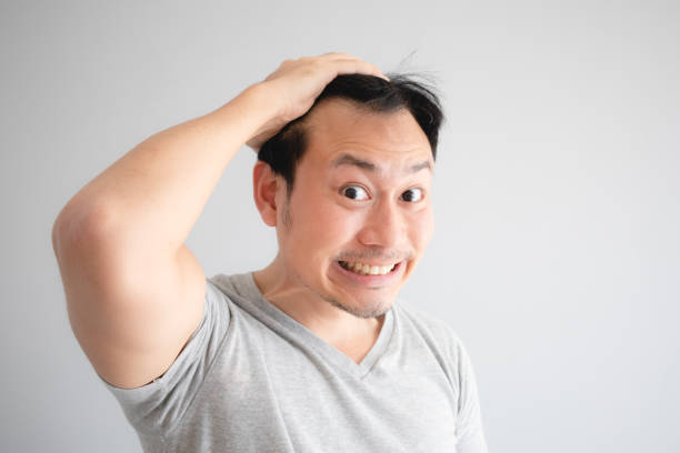 Shocked face of Asian man find himself lost hair and get bald. stock photo