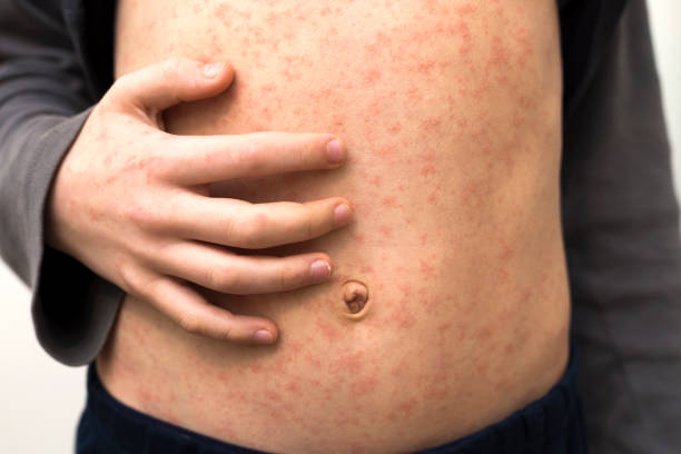 Sick child with red rash spots from measles. stock photo