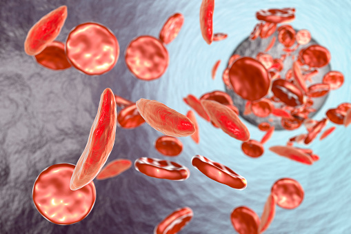 Sickle Cell Anemia Stock Photo - Download Image Now - iStock