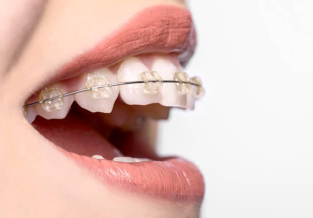 side view of teeth with braces woman mouth, side view, teeth and braces, white background. silver teeth stock pictures, royalty-free photos & images
