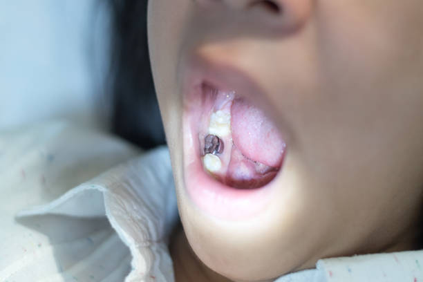 Silver amalgam crown dental filling teeth in mouth. Asia girl child with tooth sealant  rotten teeth in children stock pictures, royalty-free photos & images