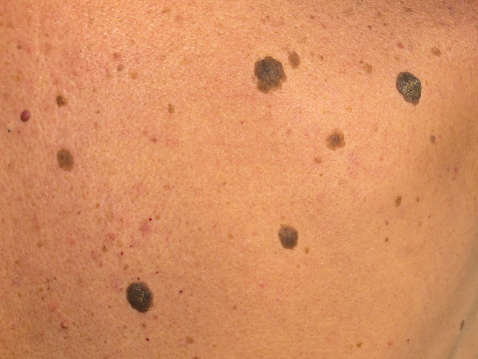 Skin abnormalities can be tears, stains, tumors, benign signs, depigmentation and warts. Seborrhoeic keratosis no cancerous skin growth, like warts and not infectious with a lot of keratin, which gives crusty layer on the top.