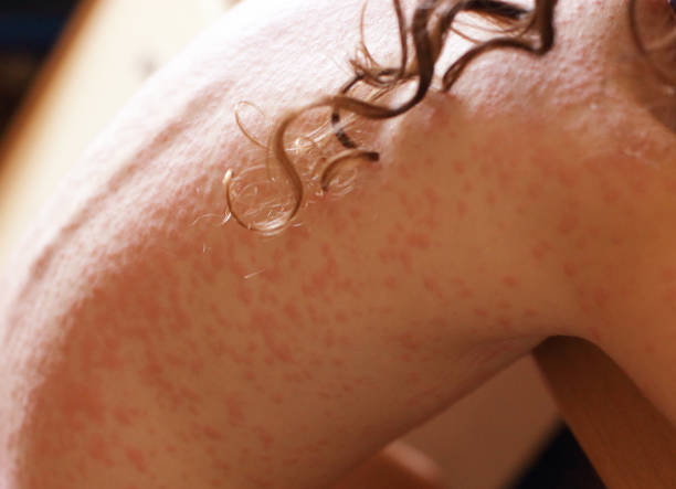 Skin allergy stock photo
