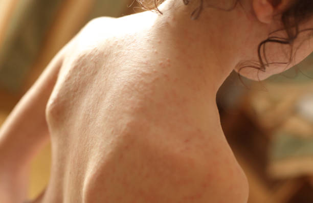 allergia cutanea - vaiolo foto e immagini stock