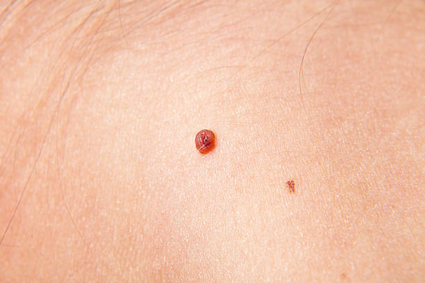 Skin cancer XXXL Skin cancer macro body hair stock pictures, royalty-free photos & images