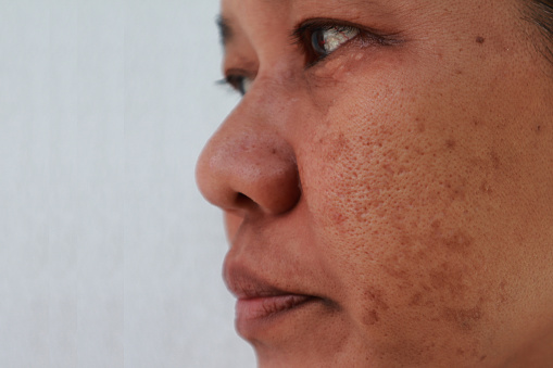 Hautproblem Closeup Haut Gesicht Asiatische Frauen Mit Fleck Melasma Dunkle Flecken Stockfoto Und Mehr Bilder Von Asiatischer Und Indischer Abstammung Istock