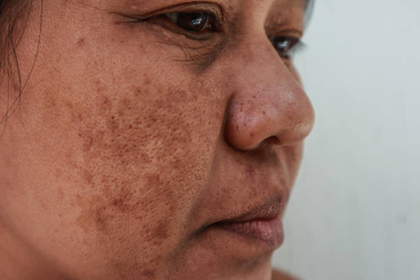 problema de pele, closeup pele rosto mulheres asiáticas com mancha melasma. - melasma - fotografias e filmes do acervo