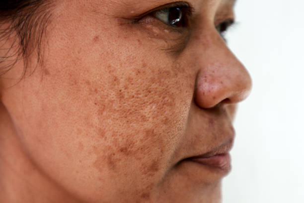 Skin problem, Closeup skin face asian women with spot melasma. Skin problem, Closeup skin face asian women with spot melasma. melasma stock pictures, royalty-free photos & images
