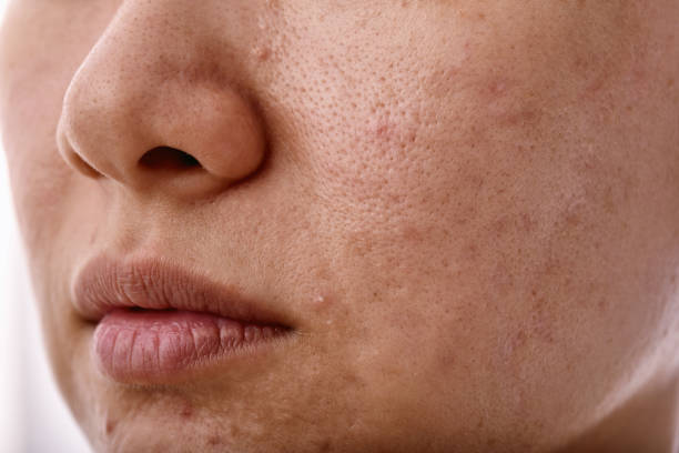Skin problem with acne diseases, Close up woman face with whitehead pimples on mouth, Scar and oily greasy face, Beauty concept. stock photo