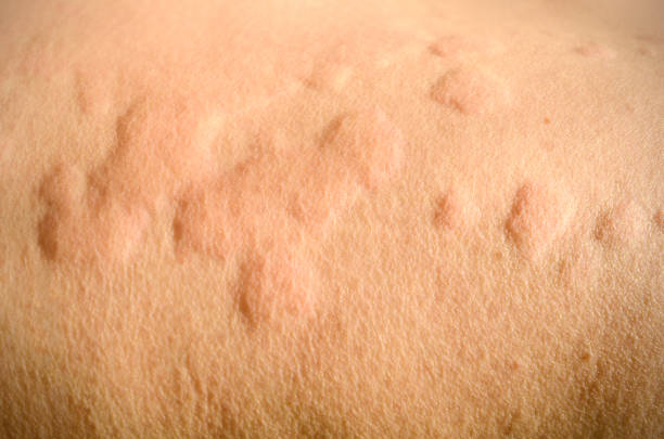 Skin rash, Urticaria, Allergic skin reaction. stock photo