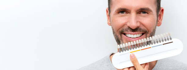 Smiling man with whitening shade guide stock photo
