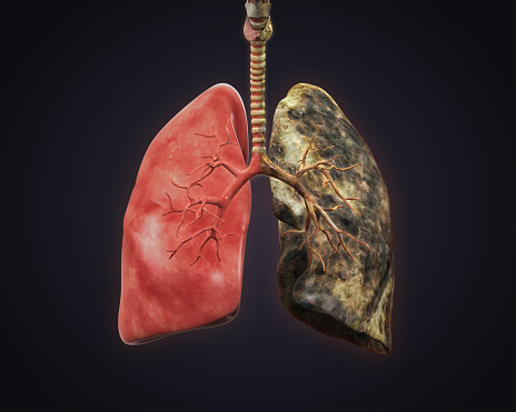 smokers-and-healthy-lung-picture-id505050189?b=1&k=20&m=505050189&s=170667a&w=0&h=scjIgS9K6rYS_sl1HAA0qzy0Wpl550vOgMKIire1DdU=