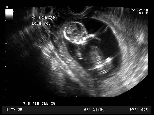 Sonogram image of 12 week old fetus stock photo