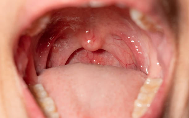Sore throat with throat swollen. Closeup open mouth with posterior pharyngeal wall swelling and uvula and tonsil. Influenza follicles in the posterior pharyngeal wall. Macro shot of lymphoid follicles stock photo