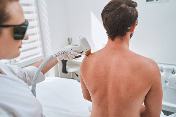 Spa client undergoing a shoulder laser hair removal stock photo
