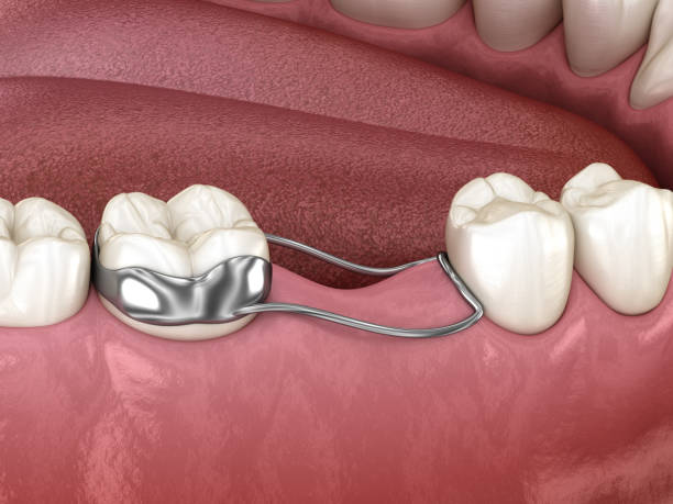 Space Maintainer Unilateral keeps from teeth shift deformatiuon after losing molar tooth. 3D illustration stock photo