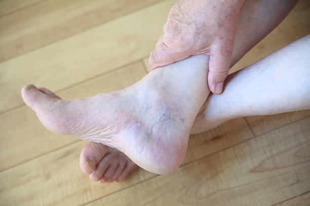 Spider veins on ankle of man stock photo