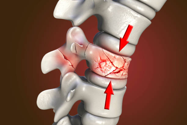 Spinal fracture, traumatic vertebral injury, illustration stock photo
