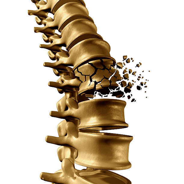Spine Fracture Spinal Fracture and traumatic vertebral injury medical concept as a human anatomy spinal column with a broken burst vertebra due to compression or other osteoporosis back disease on a white background. bone fracture stock pictures, royalty-free photos & images