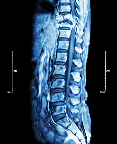 spinal twine tumors