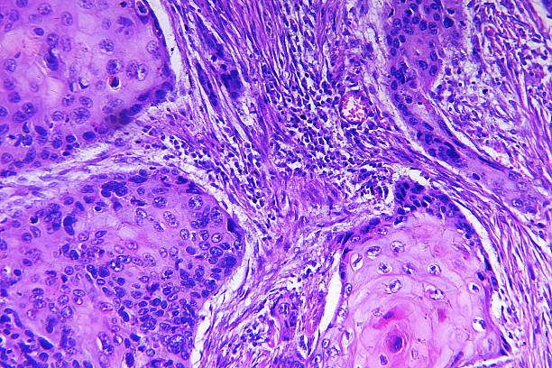 Squamous cell carcinoma of a human Squamous cell carcinoma of a human, photomicrograph panorama as seen under the microscope, 200x zoom. histology stock pictures, royalty-free photos & images