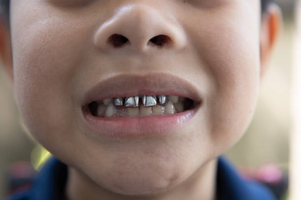stainless steel crown boy with severe tooth decay and have been replaced few of his upper incisors with stainless steel crown. silver teeth stock pictures, royalty-free photos & images