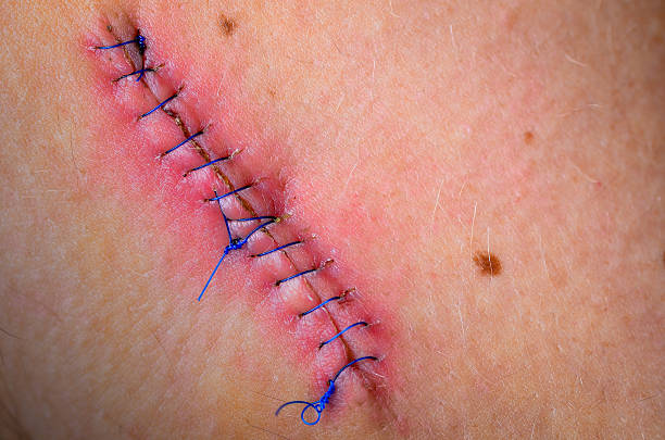 stitched up wound after mole removal surgery. - besmettelijke ziekte stockfoto's en -beelden