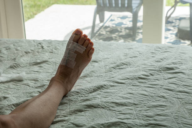 Stitches removed and foot elevated after bunion surgery stock photo