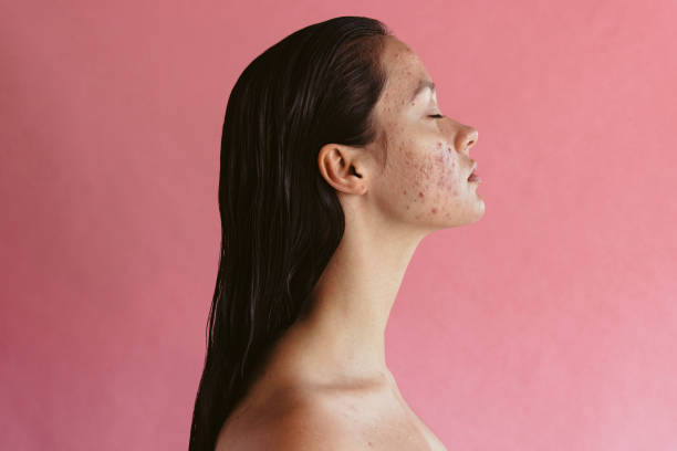 Stress can lead to acne inflammation Side view portrait of woman with acne inflammation on pink background. Skin disorders lead to depression and insecurities in women. acne stock pictures, royalty-free photos & images