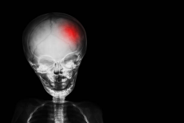 Stroke . film x-ray skull and body of child with red color at head . Neurological concept stock photo