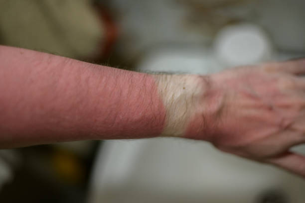 Sunburn on human hand. stock photo