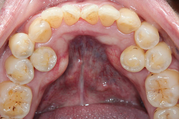 Supernumerary premolars. stock photo