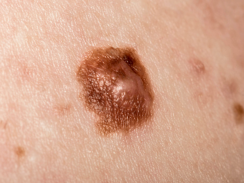 Macro image of a suspicious mole seen close up. The mole was later removed in surgery and found to be pre cancerous.