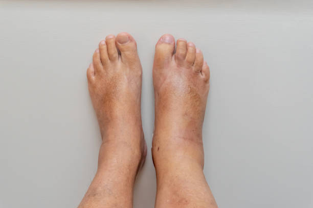 Swollen foot, ankle and leg stock photo