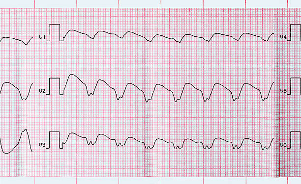 Tape ECG with paroxysmal ventricular tachycardia stock photo