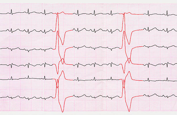 Tape ECG with ventricular premature beats (quadrigeminia) stock photo