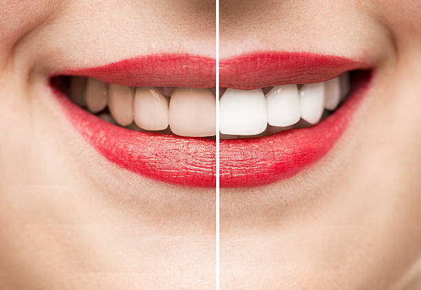 zähne vor und nach der zahnaufhellung - zahnaufhellung stock-fotos und bilder