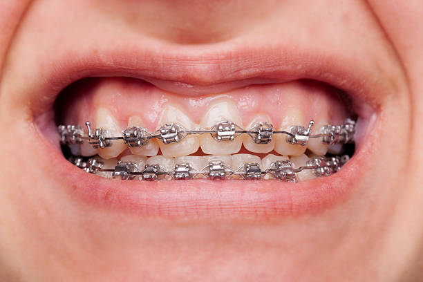Phases of Orthodontics - Orthodontics works wonders for crooked or misaligned teeth and can correct a host of dental irregularities including overbite, underbite, crossbite, and overcrowding. Straightening teeth through the use of orthodontics has many benefits, from an enhanced self-esteem to enhanced jaw function to biting, chewing, and speaking. Because the nature of orthodontic treatment is so successful and highly predictable, orthodontic treatments most likely will occur in two to three distinct phases. Generally speaking, orthodontic treatment can last anywhere from six and thirty months, depending on various factors. Namely, these factors are the severity of the irregularity, the type of orthodontic devices being used for treatment, and the diligence of the patient in following the orthodontist’s instructions. The first phase of orthodontic treatment is the planning phase. During this phase, the orthodontist will perform several types of evaluations to make an accurate diagnosis and plan to realign the teeth in the most effective and timely way. Since dental and physical problems can be related, the medical health of a patient must be evaluated before starting orthodontic treatment to ensure all medical issues are resolved before the start of treatment. The next part of the planning phase is to make a model of the patient’s mouth that the orthodontist can use to closely examine the relationships between the various structures. This is accomplished by taking dental impressions. To acquire dental impressions, patients bite down on a U-shaped metal tray filled with a liquid substance that gradually hardens to a rubber-like substance within a minute. Then, the trays are removed from the mouth, filled with plaster, and used to create a plaster model of the mouth. Another part of the planning phase is to obtain panoramic x-rays, computer-generated images, and photographs. These various images are all used to help the orthodontist locate potential trouble areas, as well as provide “before, during, and after” images to evaluate progress. The second phase of orthodontic treatment is called the active phase. The active phase refers to the time when dental appliances are being worn or used by the patient. There are a variety of possible dental appliances that can be used. They range from fixed appliances, such as traditional braces, to removable appliances, such as Invisalign or headgear. The most common type of treatment is traditional braces, however. During the active phase, the orthodontist will make several adjustments to whatever appliance is being used to obtain the desired results. The third and final phase of orthodontic treatment is the retention phase. This phase occurs once the teeth have moved into the desired position and the use of the dental appliance ceases. During the retention phase, patients are expected to wear a retainer for a specific amount of time per day to ensure that the teeth do not shift back to their previous positions. In the retention phase, the teeth are stabilized in their new position by the jawbone growing around them and holding them into place.