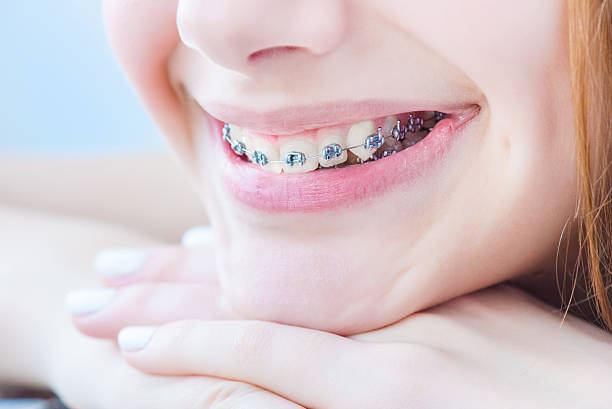 1,144 Braces Colors For Girls Teeth Stock Photos, Pictures &amp; Royalty-Free Images - iStock