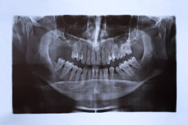 Best Canine Tooth Stock Photos, Pictures & Royalty-Free ...