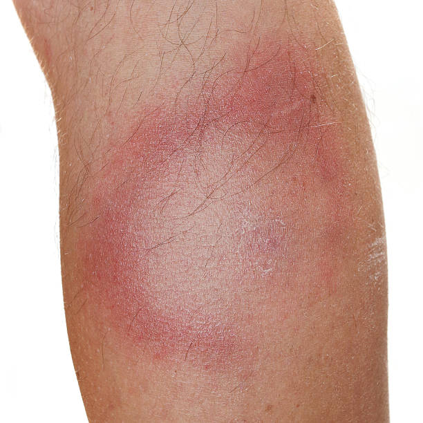 The Erythema Migrans rash, Lyme disease. The Erythema Migrans rash often seen in the early stage of Lyme disease. It can appear after a tick or mosquito bite. It is an actual skin infection with the Lyme bacteria, Borrelia burgdorferi. lyme disease stock pictures, royalty-free photos & images