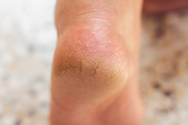 The heel of foot with bad skin is covered with cracks. The concept using medical treatment with moisturizers and also vedekure and peeling of wound healing and pain while walking swatch dermatologist stock photo